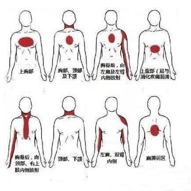 心肌梗死年輕化，如何預防