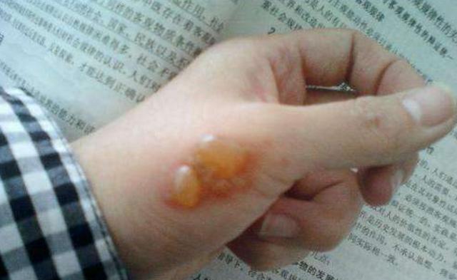 不小心被燙傷怎麼辦？別慌，教你一招，快速止痛不留疤  