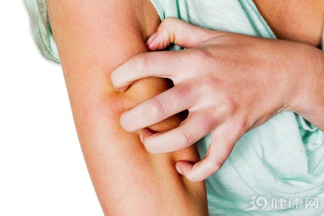 被蚊子叮了如何快速止癢？醫生說用它效果更好！