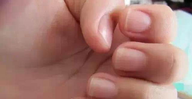 你的指甲上有一道道直線嗎？那你就要特別小心了！！可能是這種重大疾病的微兆…