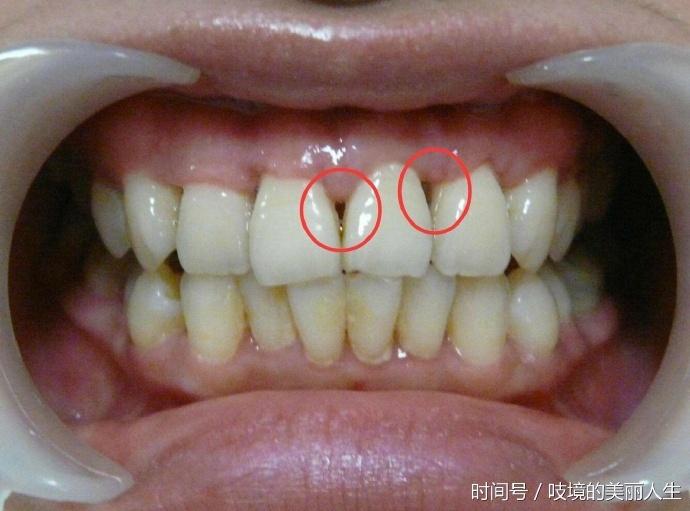 牙齦一旦萎縮，就容易「塞牙」、「牙根酸痛」，這方法可以幫到你，很直接！！
