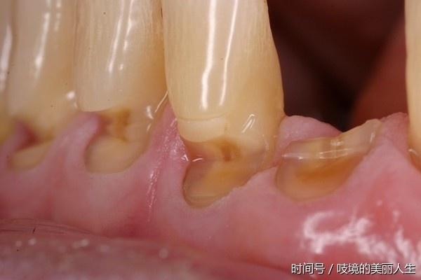 牙齦一旦萎縮，就容易「塞牙」、「牙根酸痛」，這方法可以幫到你，很直接！！
