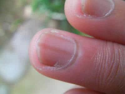如果手指指甲上出現這條線，要當心是惡癌來襲！ - COCO大馬