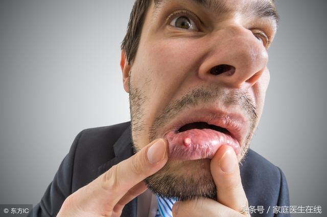 口腔潰瘍怎麼治？5個「小偏方」當天見效，拿走不謝！
