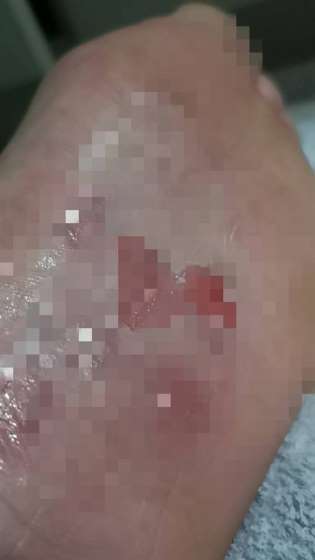 王仁甫玩到出意外 照片曝光嚇壞眾人  