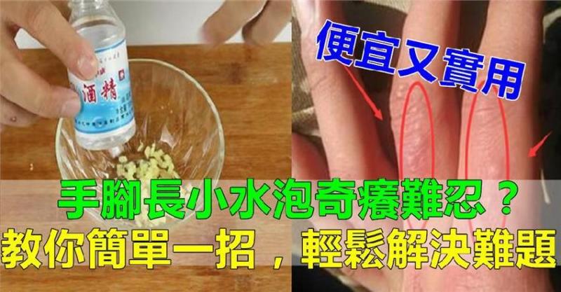 手腳長小水泡奇癢難忍？教你簡單一招，輕鬆解決難題，省錢又省心！（很實用） 
