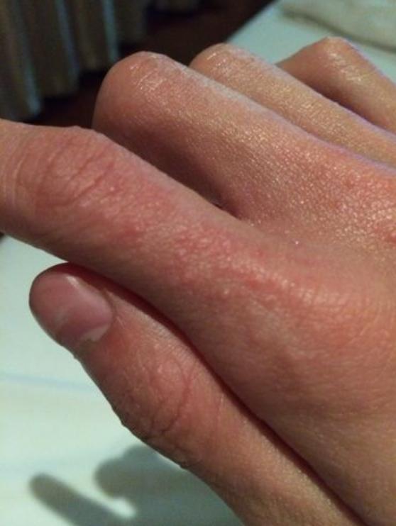 手腳長小水泡奇癢難忍？教你簡單一招，輕鬆解決難題，省錢又省心！（很實用） 