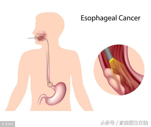 燙口的食物與食管癌，到底有什麼關係？給大家講清楚