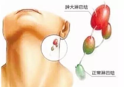 脖子長小肉粒！說明你身體出了問題！