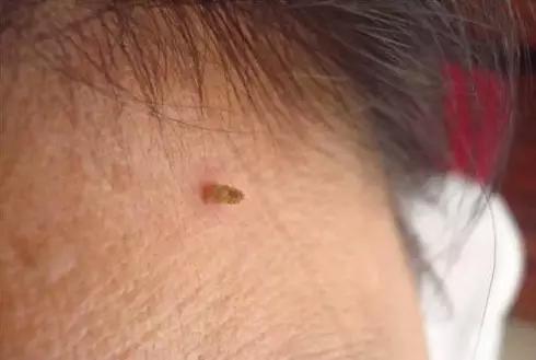脖子長小肉粒！說明你身體出了問題！
