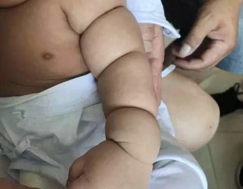 寶寶剛出生三個月，胖嘟嘟的，醫生卻說要做截肢手術