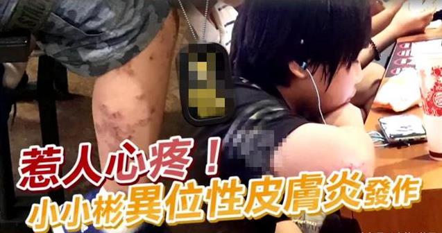 14歲小小彬被爸爸當搖錢樹來還房貸養全家！如今近照曝光，手腳潰爛令人心疼！