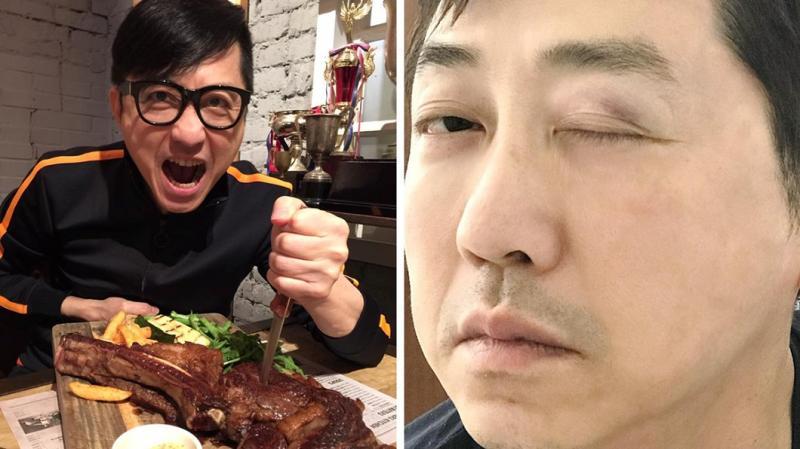 庾澄慶曝被家暴　右眼瘀青腫脹