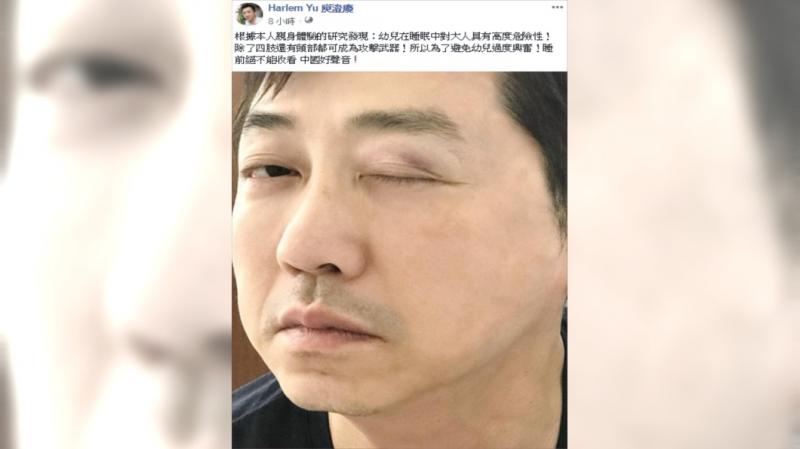 庾澄慶曝被家暴　右眼瘀青腫脹