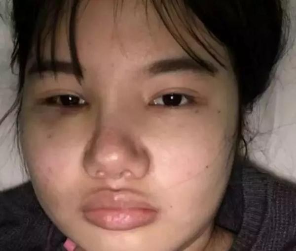 我想變楊冪：女粉砸450萬削骨整成楊冪，整容後全民跪了