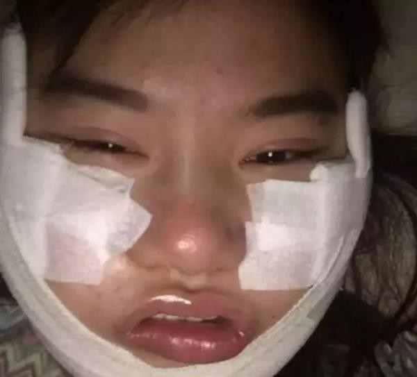 我想變楊冪：女粉砸450萬削骨整成楊冪，整容後全民跪了