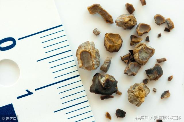 結石的產生，與水質息息相關，這些因果關係弄明白了嗎？