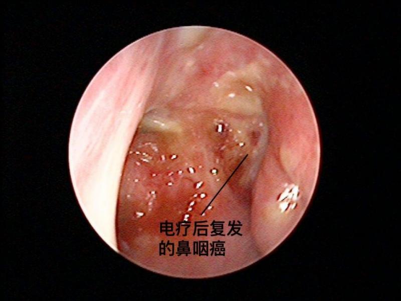 【李宗偉患癌】什麼是鼻咽癌？如發現有這7個症狀，你就要注意了！