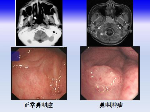 認識什麼是鼻咽癌？     