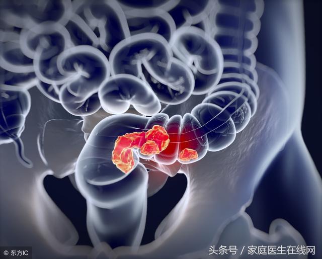 為什麼很多人都得了結直腸癌？醫生慢悠悠地說了這些秘密
