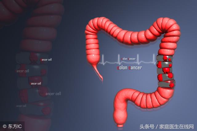 為什麼很多人都得了結直腸癌？醫生慢悠悠地說了這些秘密