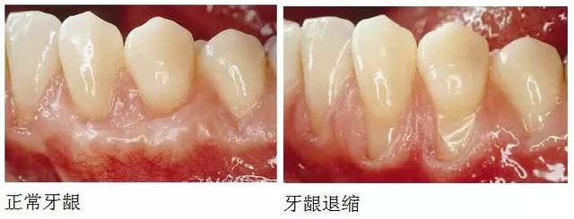 牙齦退縮，牙根暴露，不敢刷牙怎麼辦？