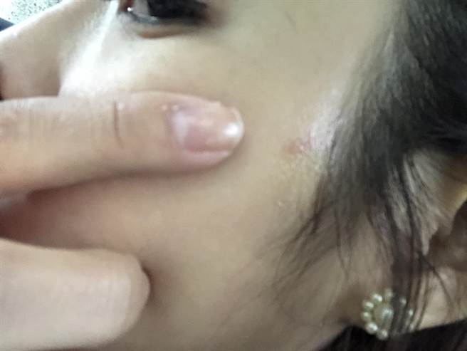 【獨家／女星遭電棒熱吻臉頰險毀容】