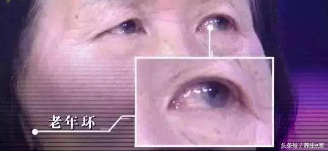 不論男女，臉上若有5種變化，小心高血脂！3樣食物再想吃也要忍忍