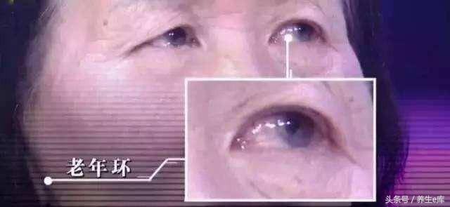 血脂高，臉先知，多食「3物」，多喝3水，少做3事，可防血栓！