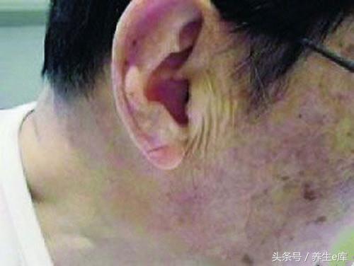 血脂高，臉先知，多食「3物」，多喝3水，少做3事，可防血栓！
