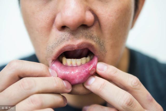 口腔潰瘍久治難愈，關鍵「七分養」，做好5件小事能預防！