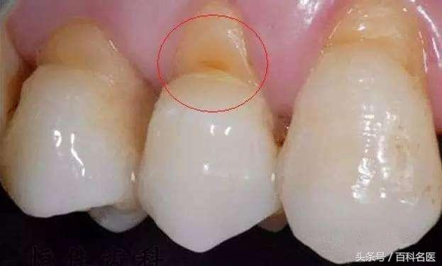 你是橫著刷牙還是豎著刷牙？橫著刷會導致這3種疾病，你還不改嗎