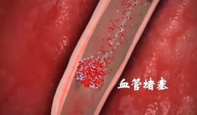 血管堵塞的真兇找到了！醫生建議：堅持3點，血管越來越通暢
