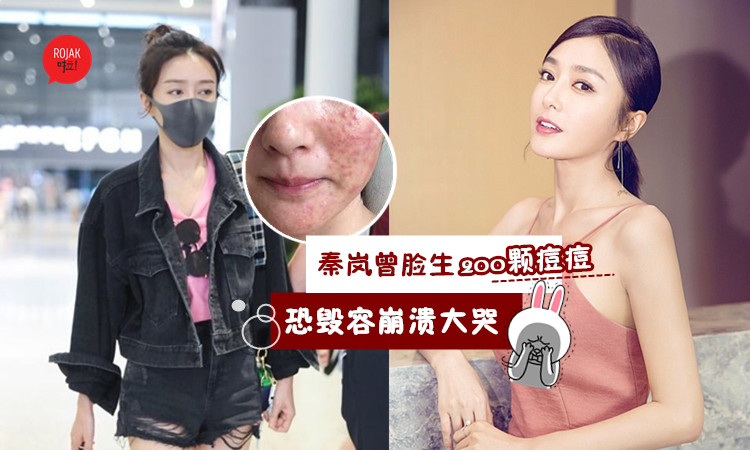 怎麼可能?!『皇后秦嵐』曾全臉冒200顆痘痘．爛臉崩潰大哭！網友：完全看不出！