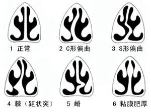 嬰幼兒鼻塞有什麼辦法？