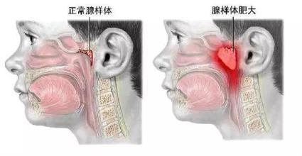 嬰幼兒鼻塞有什麼辦法？