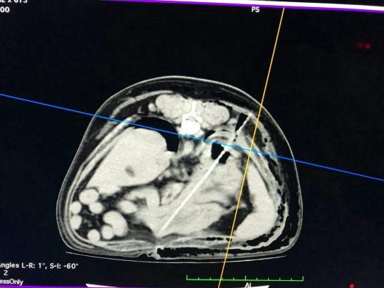 巴哥犬把整支烤肉串吃進肚子裡　X光照把主人嚇傻：手術費23萬