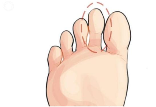心理測試：你的哪個腳趾最長？測出你十年後的社會地位