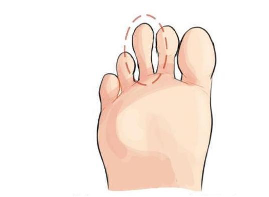 心理測試：你的哪個腳趾最長？測出你十年後的社會地位