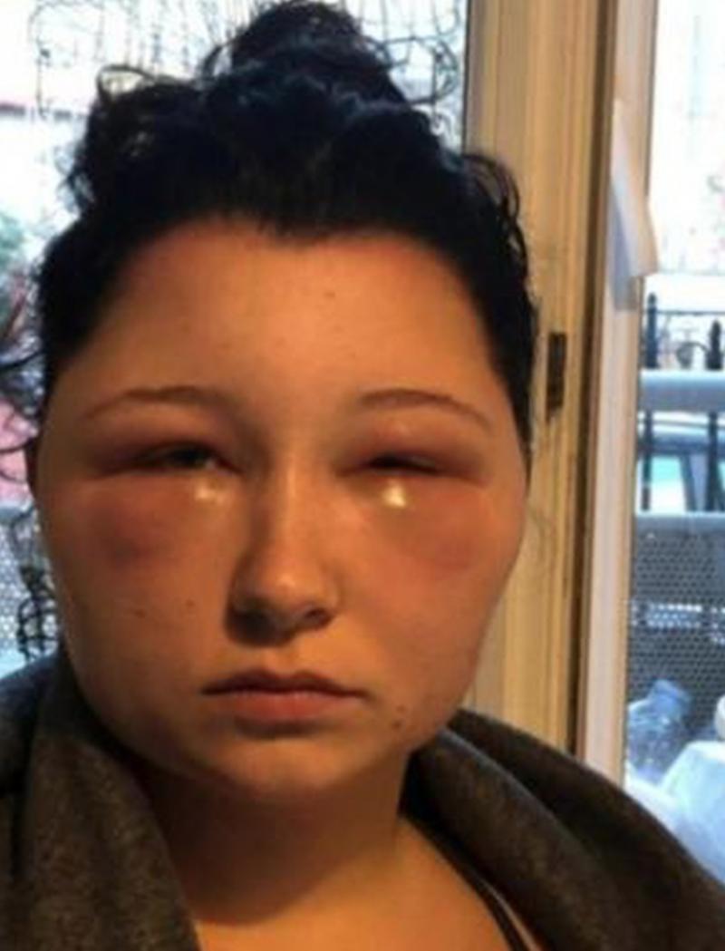 對染髮劑敏感，法國女學生「臉部腫脹」，慘變「燈泡頭」：「我差點死掉！」