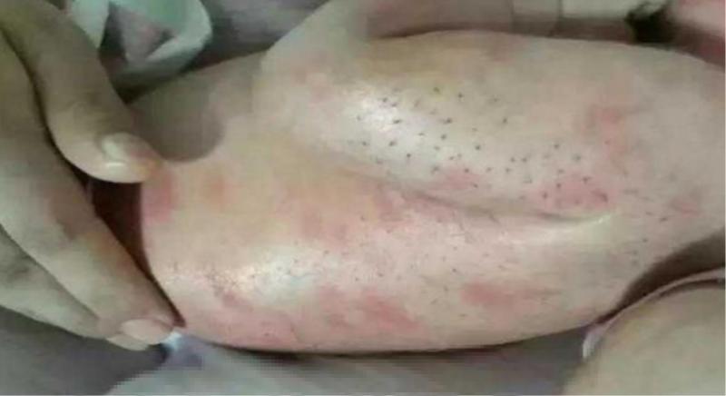 女子發現女兒身上有「刺」,女子將其全部拔掉,結果女兒去世.!