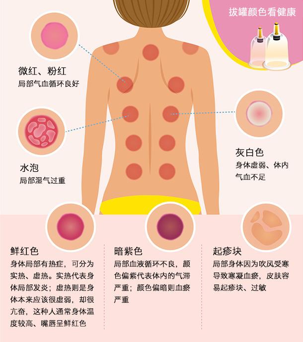 拔罐看色辨健康，一張圖秒懂身體狀況，值得收藏