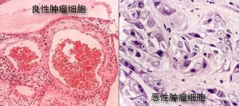 腫瘤的剋星，竟然是一種野菜，富含7種抗癌物質，終於被重視 