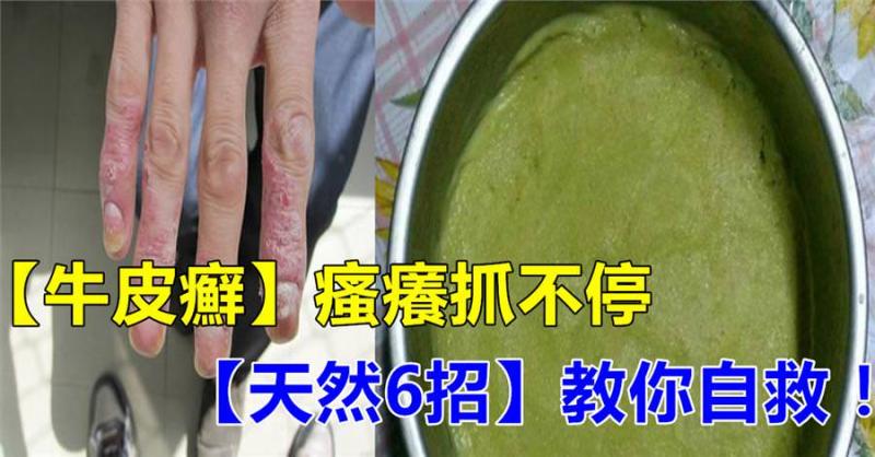 「牛皮癬」搔癢抓不停？「天然6招」鎮靜又抗炎，自救「紅斑、脫屑」必須學！