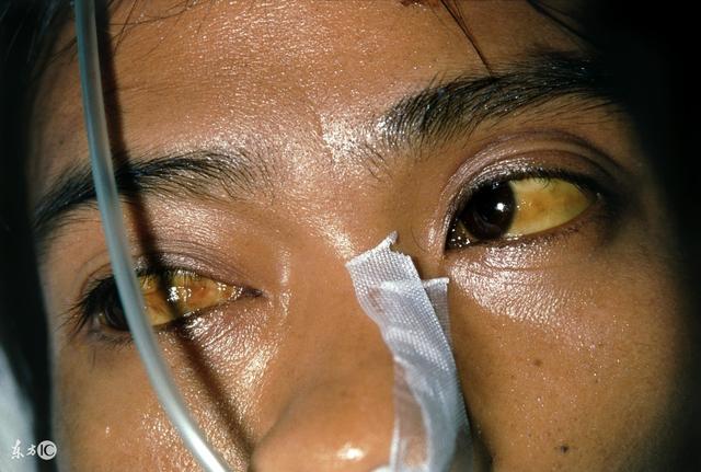 26歲女查出肝癌離世，醫生解釋：兩個習慣害的！