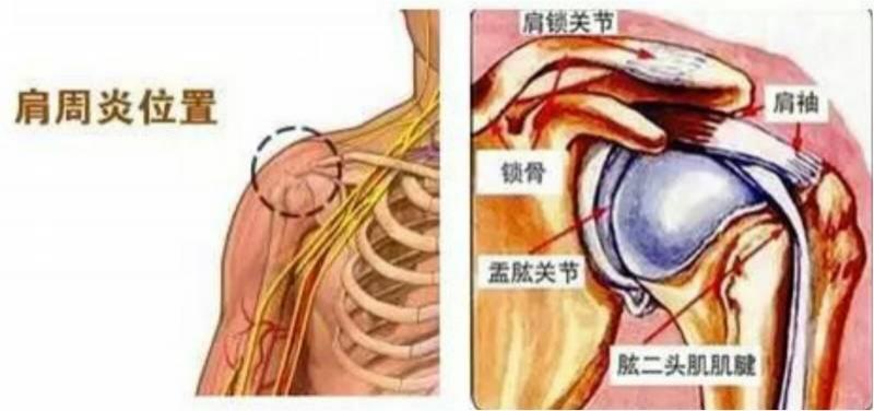 患有肩周炎，疼到晚上難以入眠，幸得一「藥方」三個月後就把肩周炎治好了！