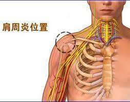 患有肩周炎，疼到晚上難以入眠，幸得一「藥方」三個月後就把肩周炎治好了！