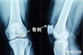 一個民間治癒率極高的「骨質增生」配方，基本上都是一副藥既愈，不再復發！