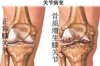 一個民間治癒率極高的「骨質增生」配方，基本上都是一副藥既愈，不再復發！