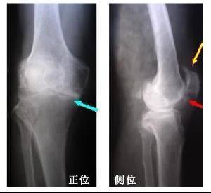 一個民間治癒率極高的「骨質增生」配方，基本上都是一副藥既愈，不再復發！